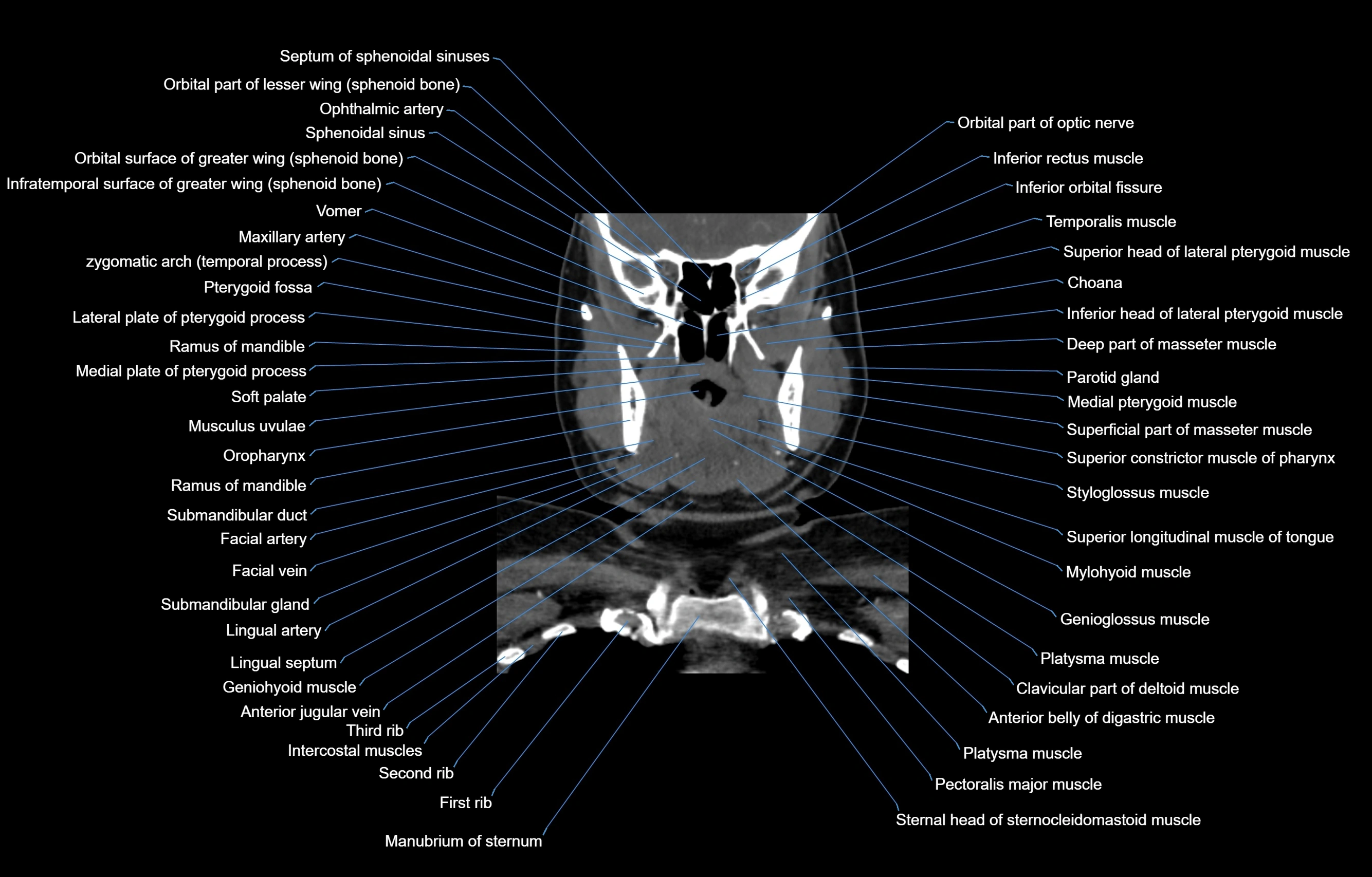 CT Neck coronal  cross sectional anatomy labelled 3D  radiology  image-00025.webp